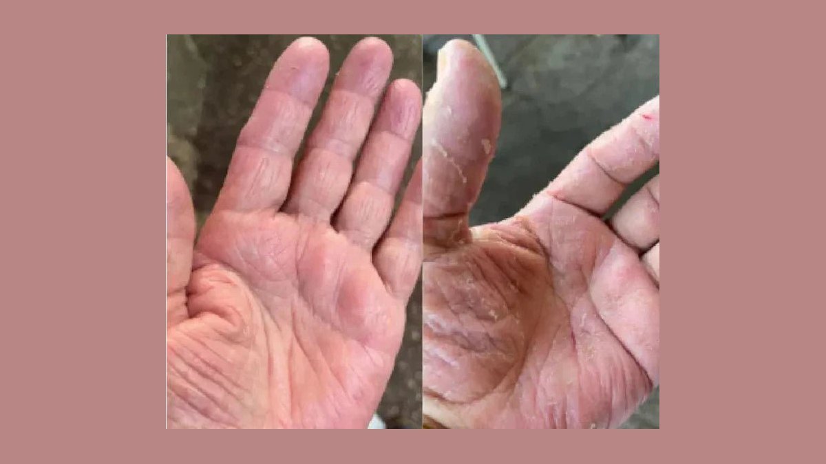 How to Repair a Damaged Skin Barrier Fast