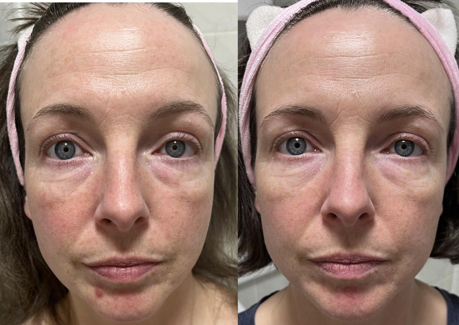 Can You Use Azelaic Acid and Niacinamide Together